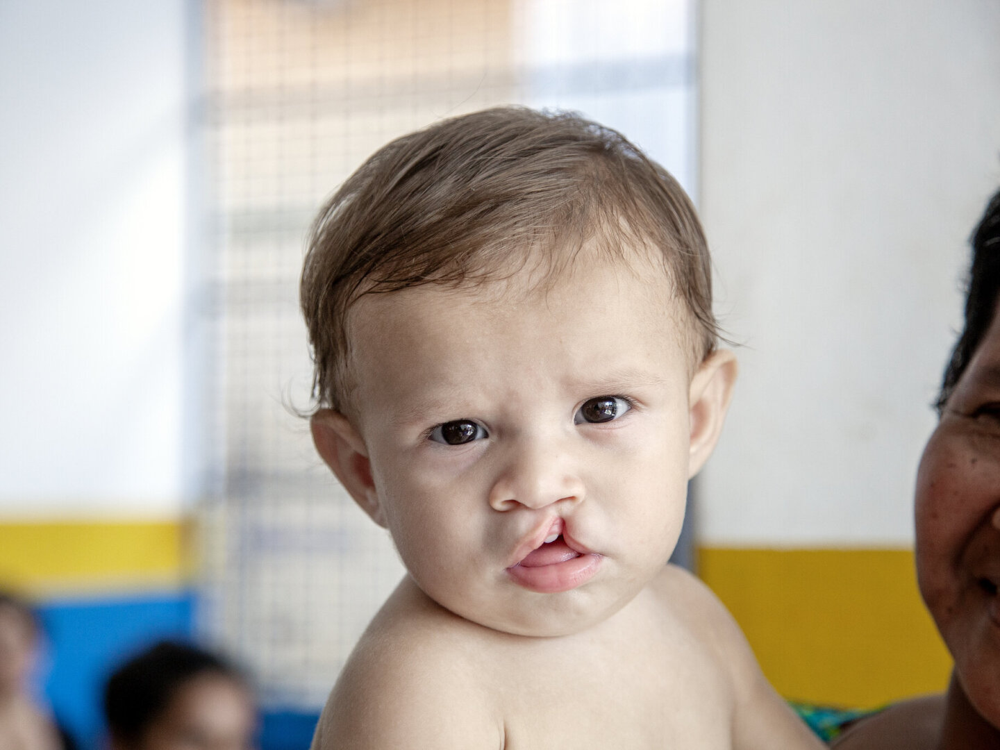 Fredy, before surgery.