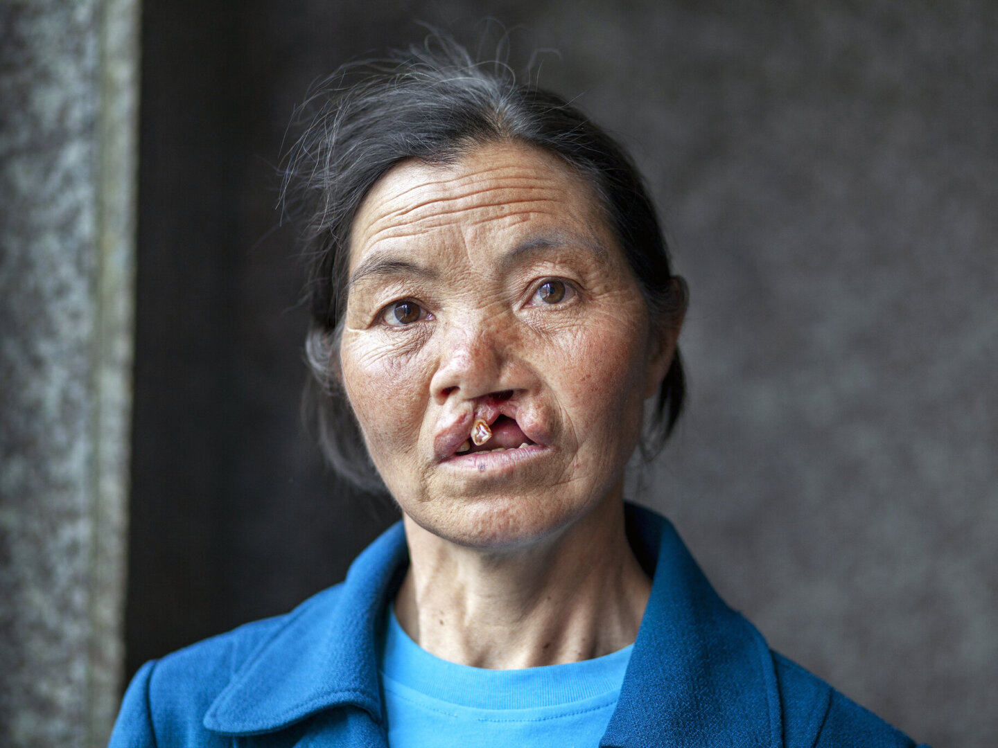 Rong Zhen, 57, before surgery.
