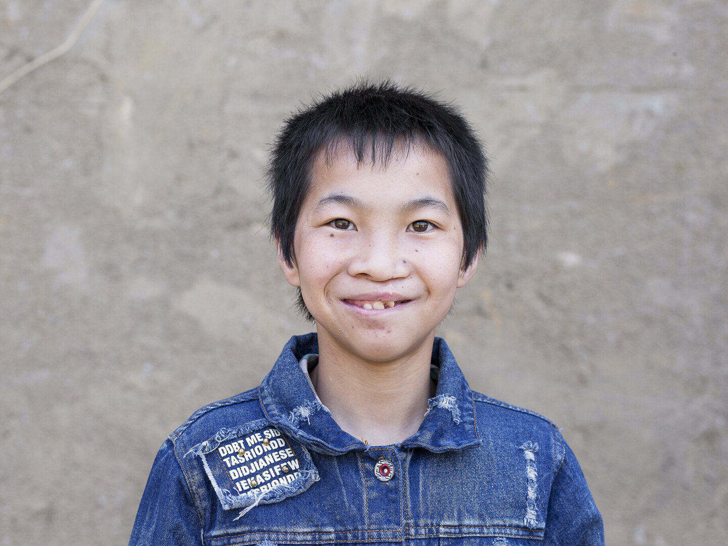 Lan smiles for the camera, after surgery.