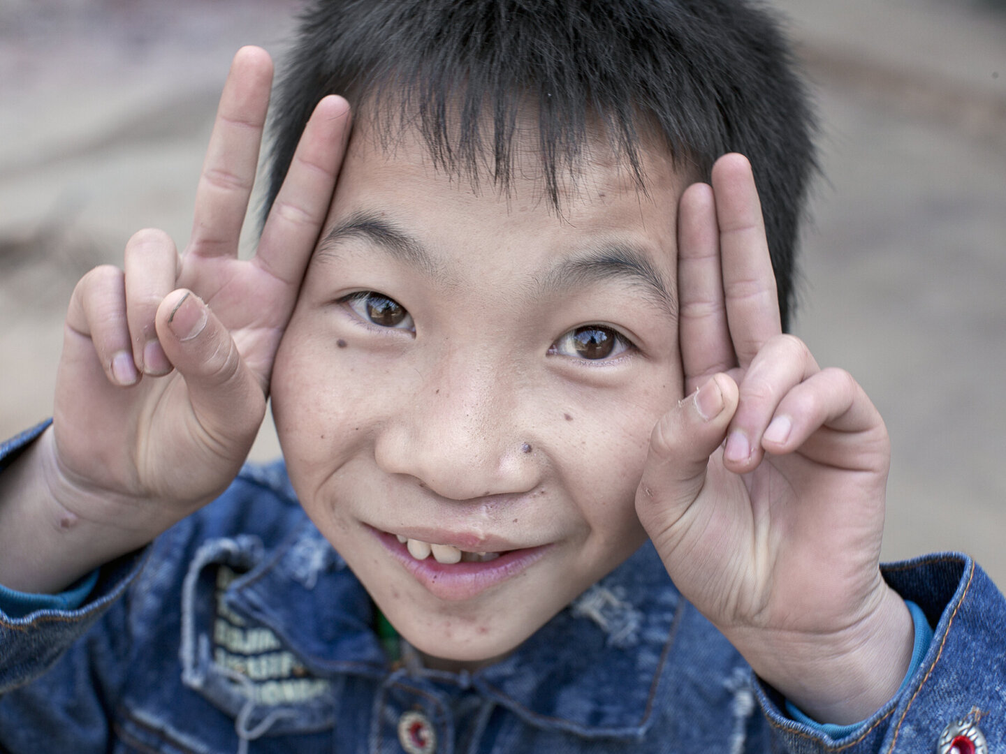 Shijun smiles wide one year after surgery.