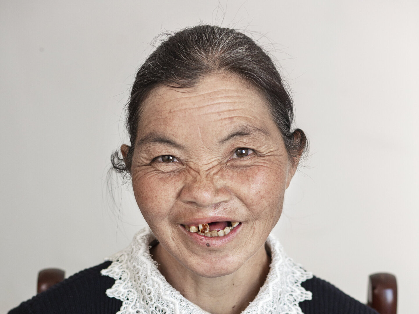 Rong Zhen, after surgery.