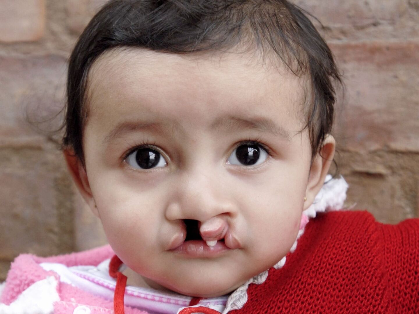 Laura, before surgery.