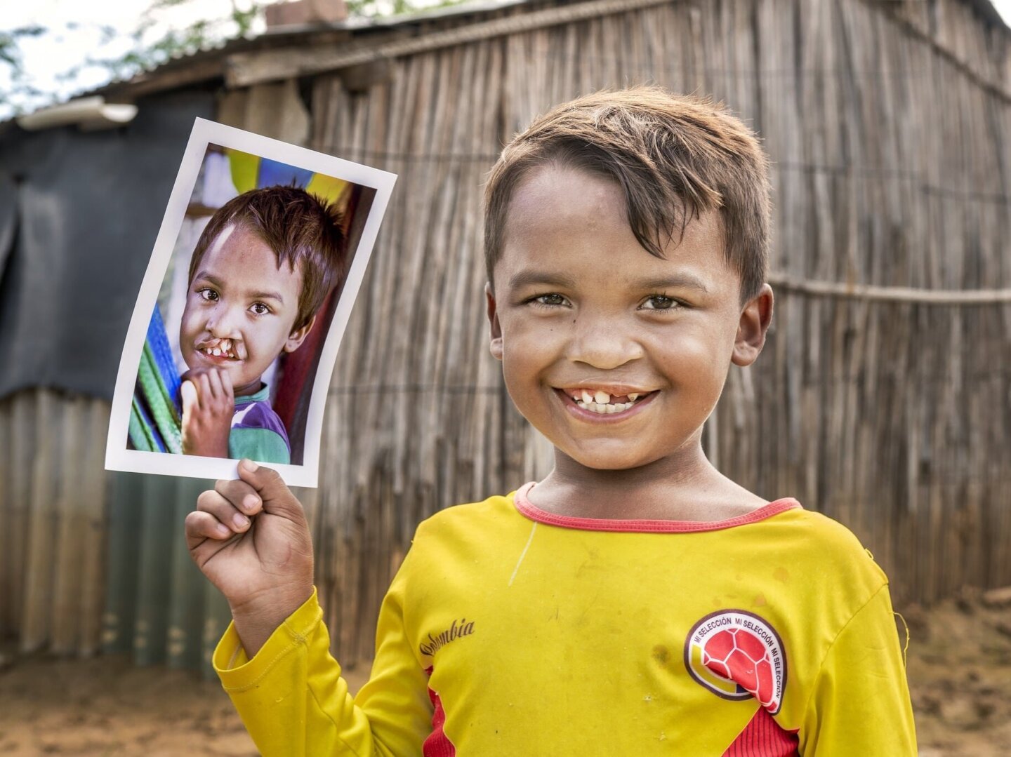 Pedro holds his before photo. He is one of the patients with cleft conditions that Operation Smile has treated.