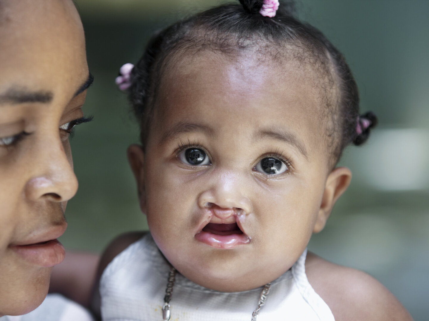 Germanyony, before surgery.