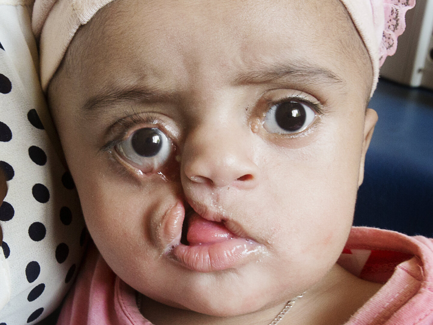 Meheftehe, before surgery.