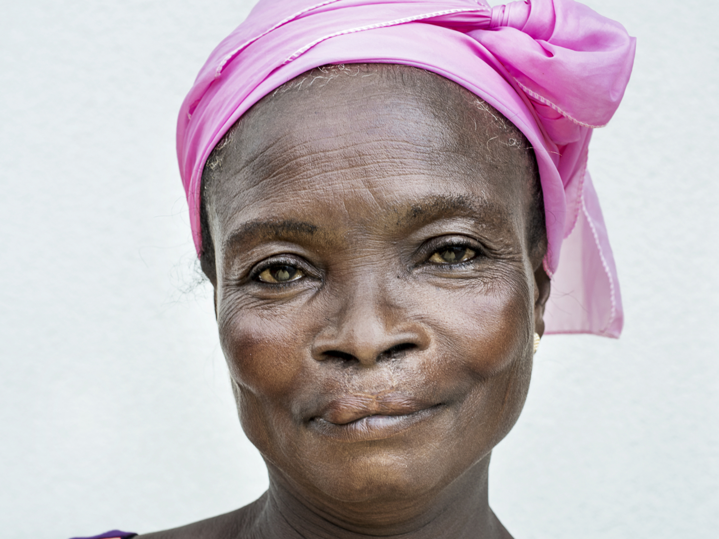 Akosua shares her new smile six months following her cleft surgery with Operation Smile Ghana.