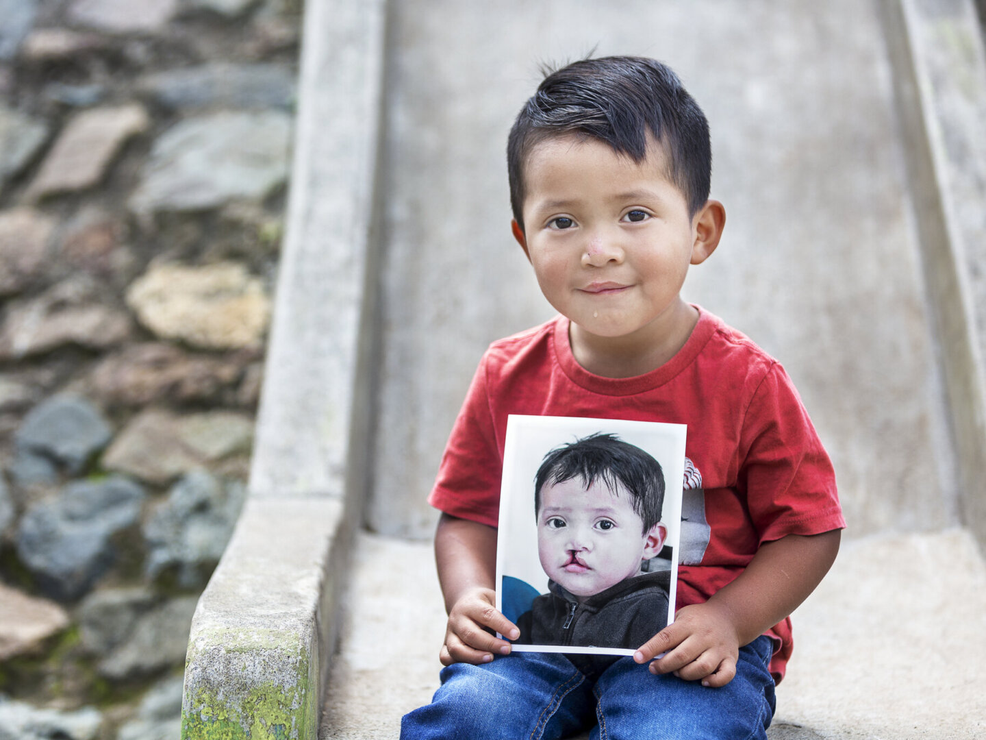 Brandon, before surgery.