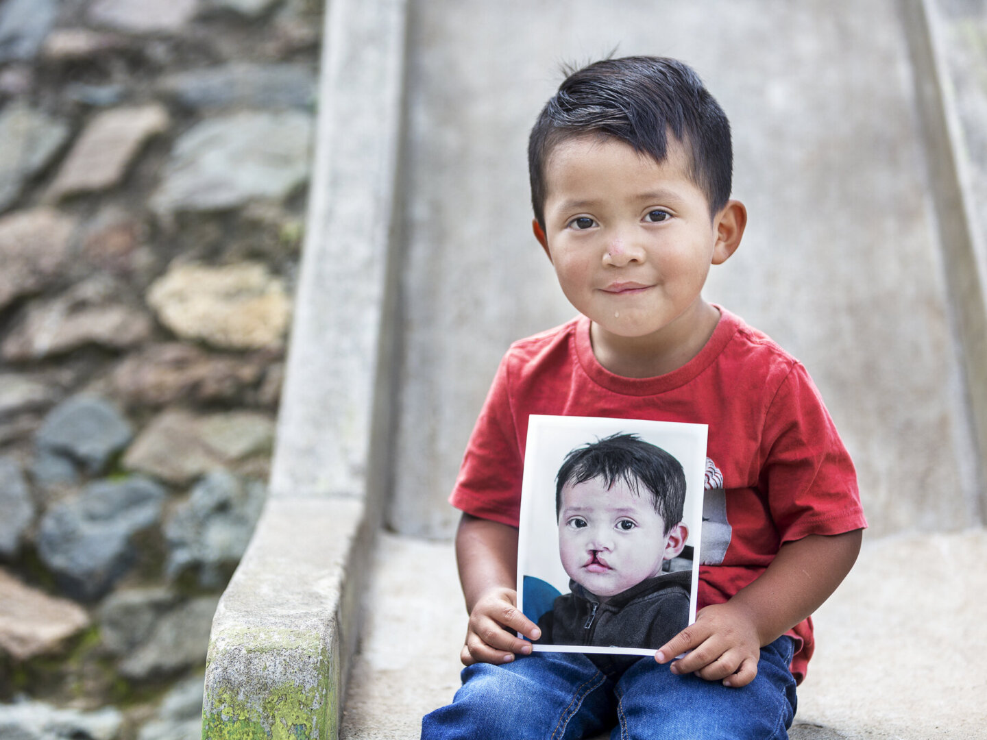 Brandon, before surgery.