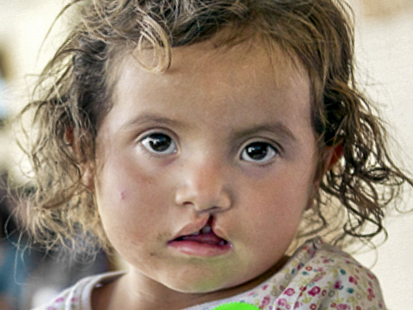 Yitci, before surgery.