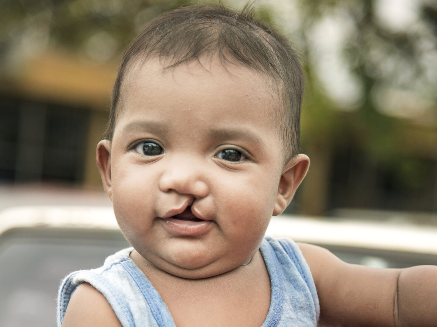 Erick, before surgery.