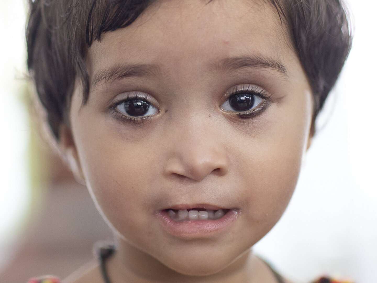 One year after her life-changing cleft lip surgery, 18-month-old Dilfa shares her beautiful smile after receiving care from Operation Smile India.