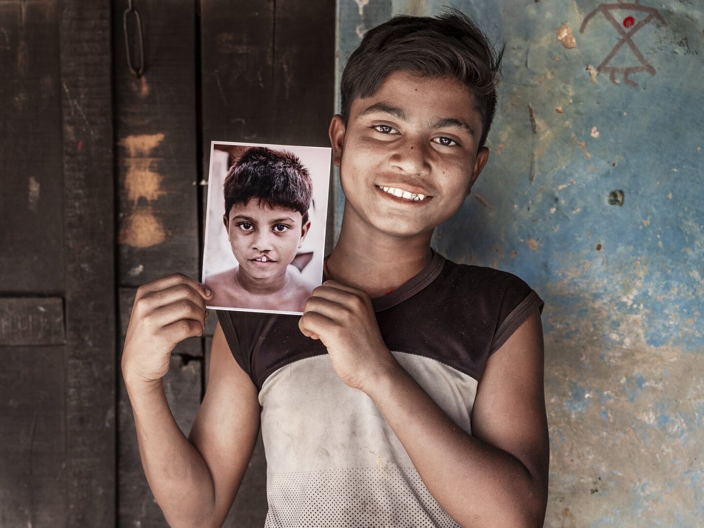 Bipul holds his before photo while smiling for the camera. Gifts from corporate partners help make care to patients like Bipul possible.