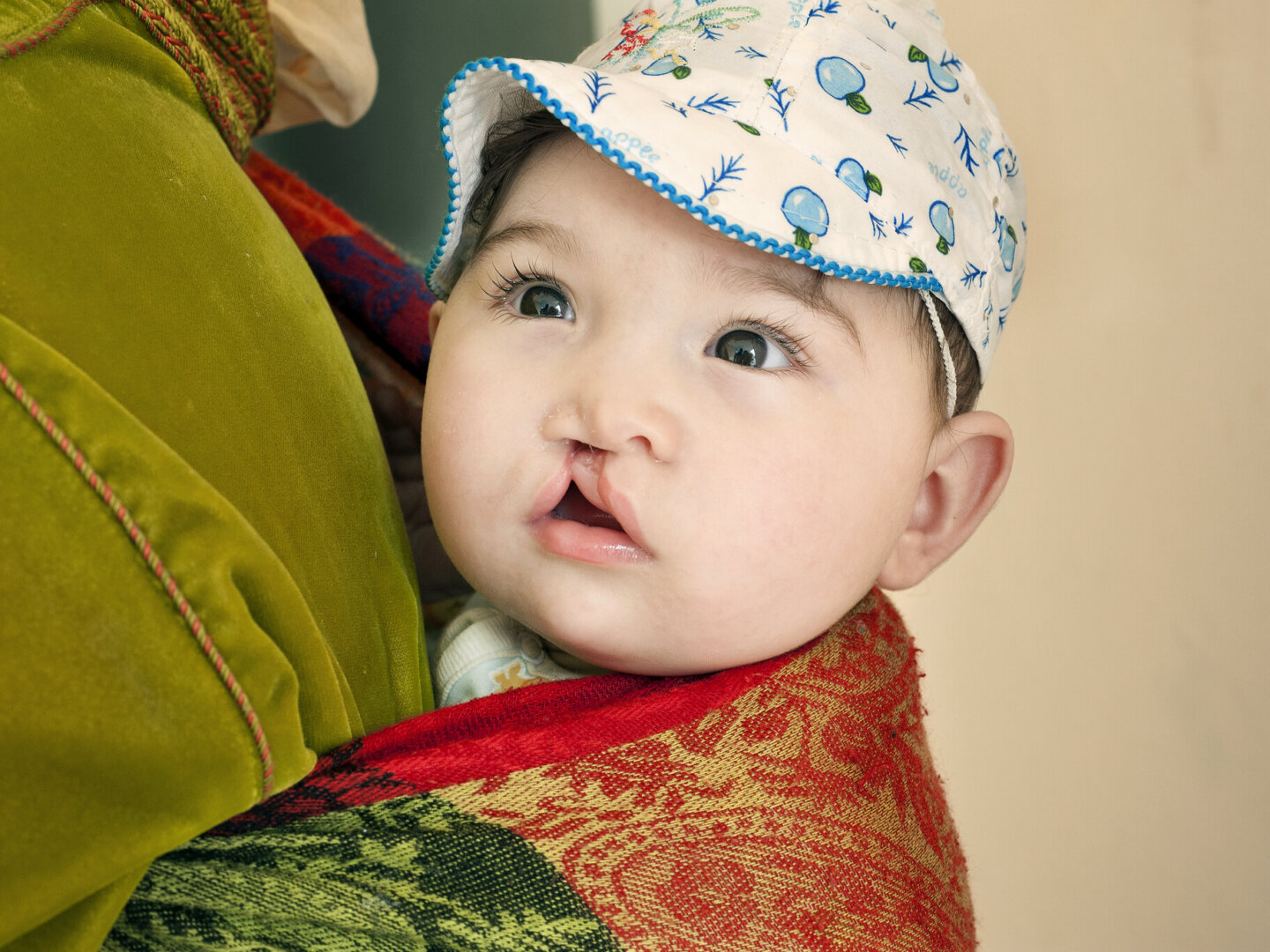 Six-month-old Rania, before surgery.