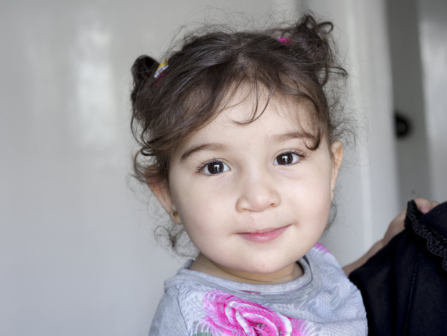 Rania, a year after surgery.