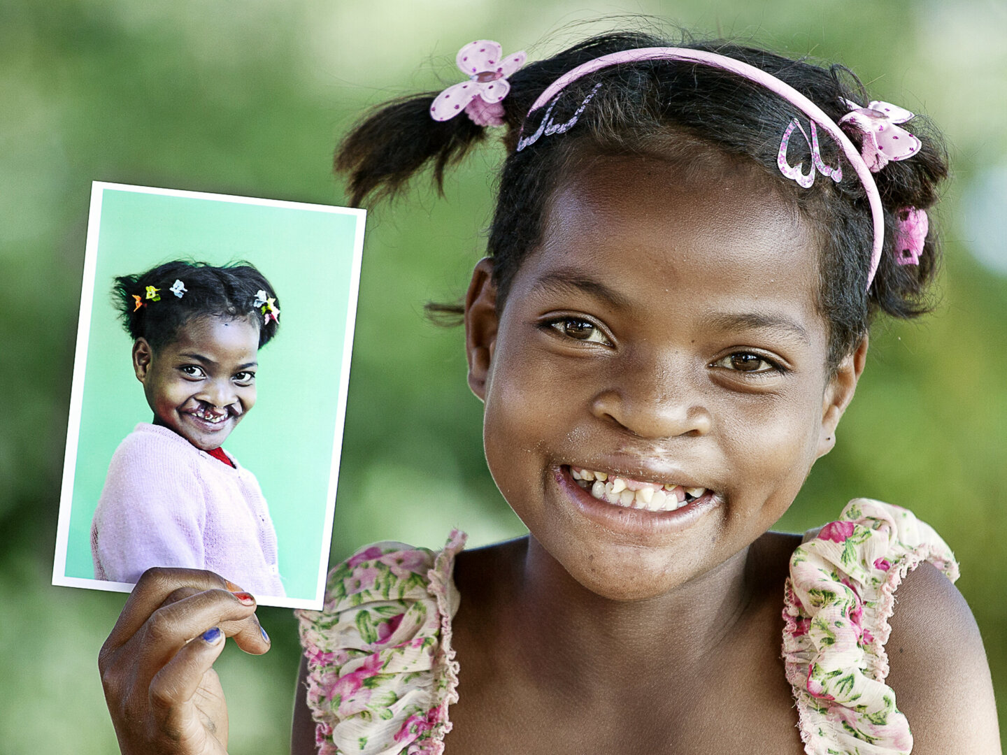 Clara shares her new smiles after her life-changing cleft surgery.
