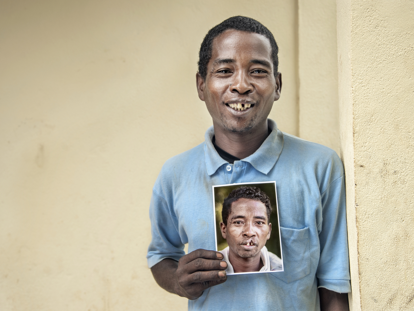 Zafilahy, after surgery.