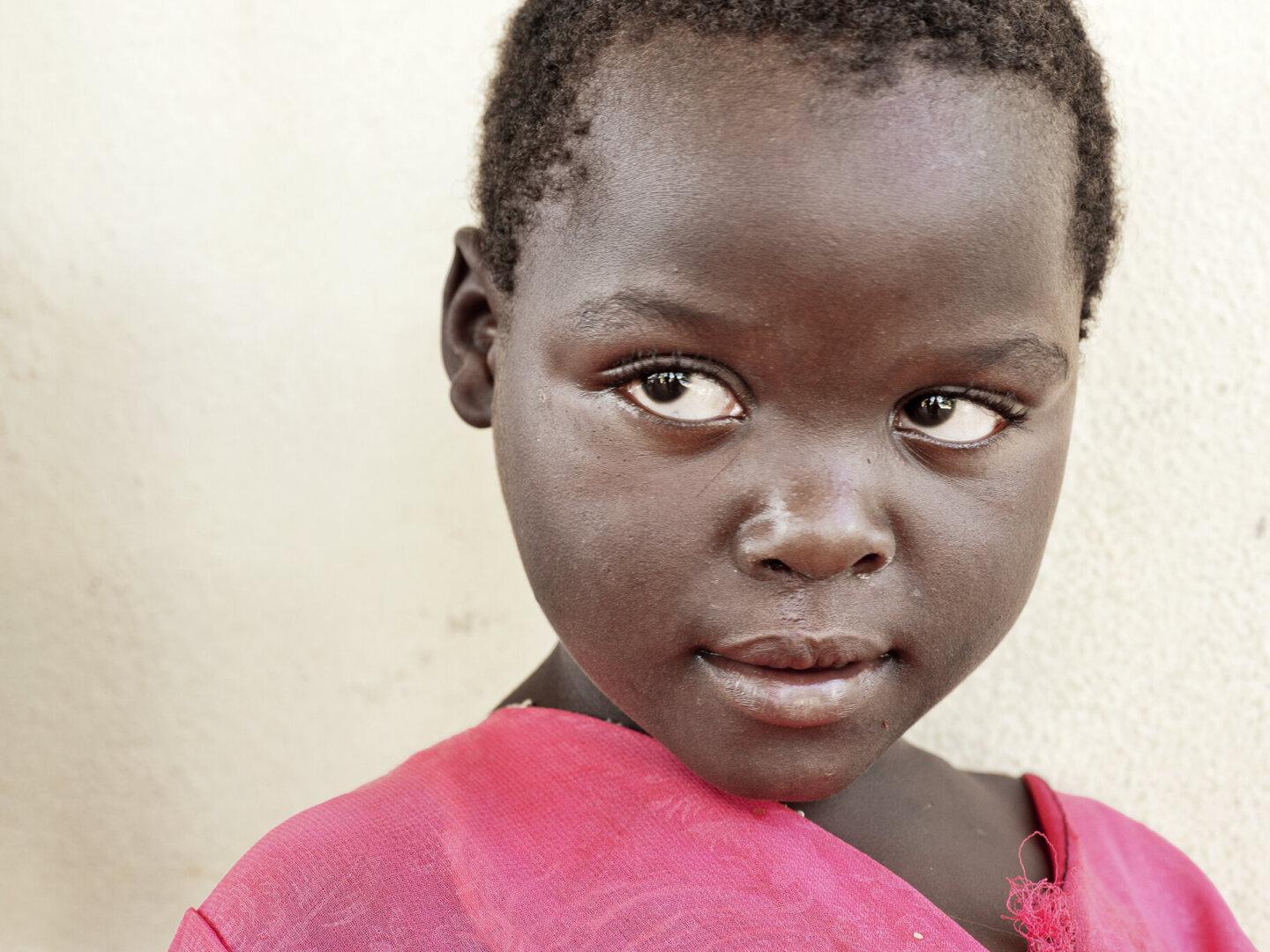 Ziyalesi, one year after cleft surgery.