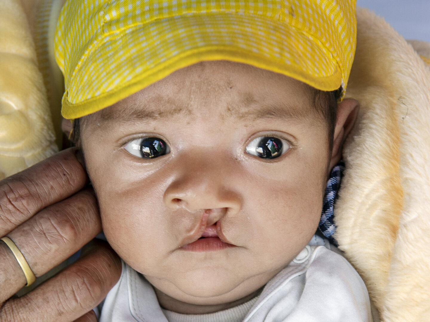Two-month-old Kyungmin during screening day of Operation Smile Peru's 2019 surgical program.