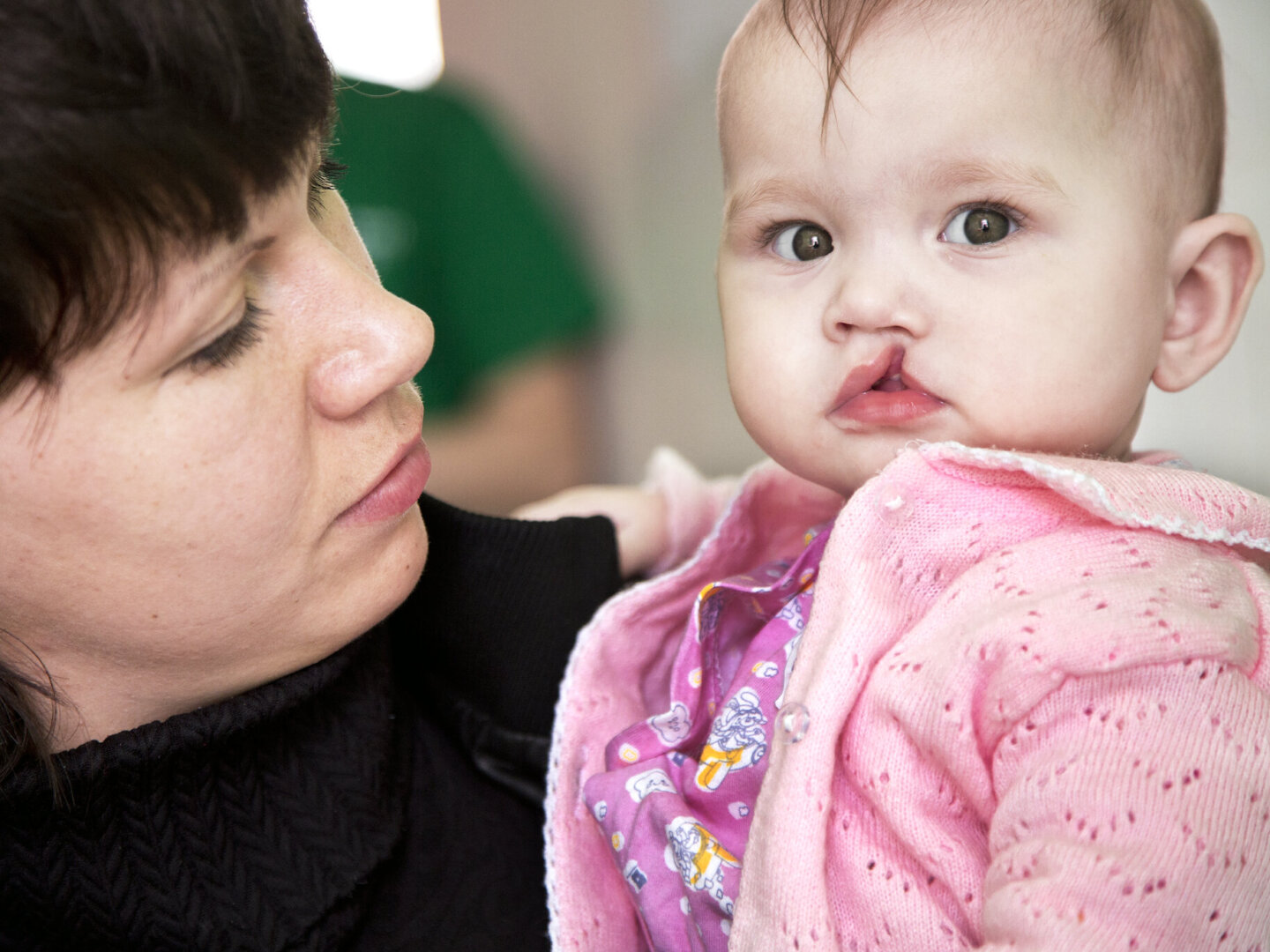 Milana, before surgery.