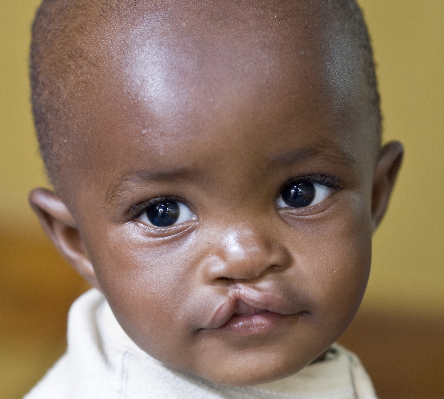 Alejandro, before surgery.