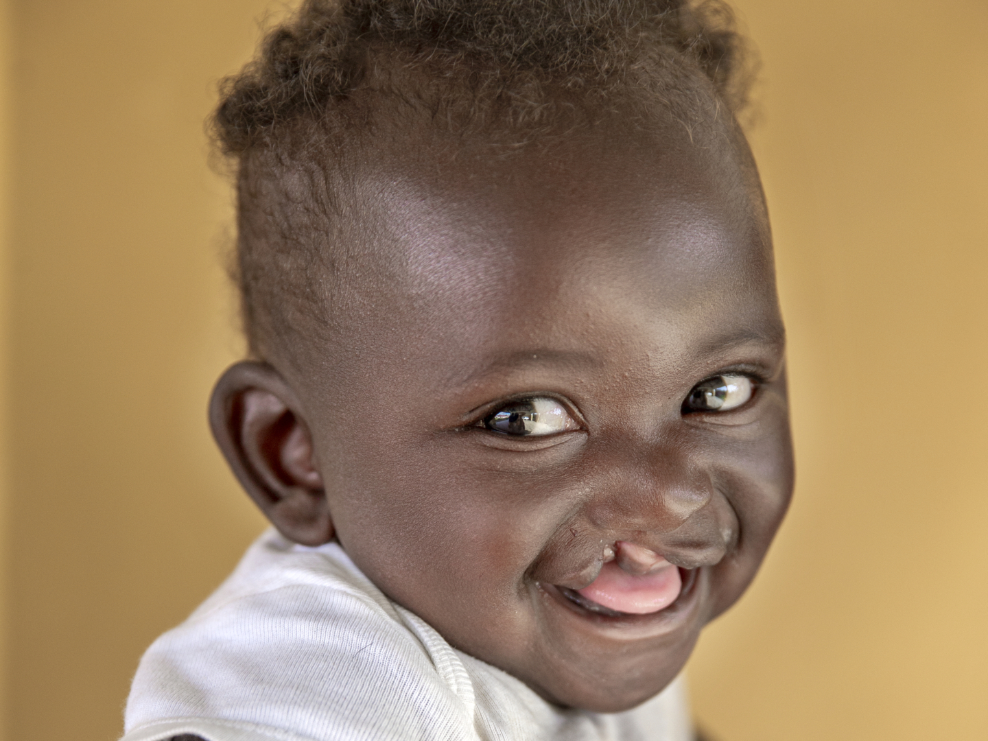 Adolphe, before surgery.