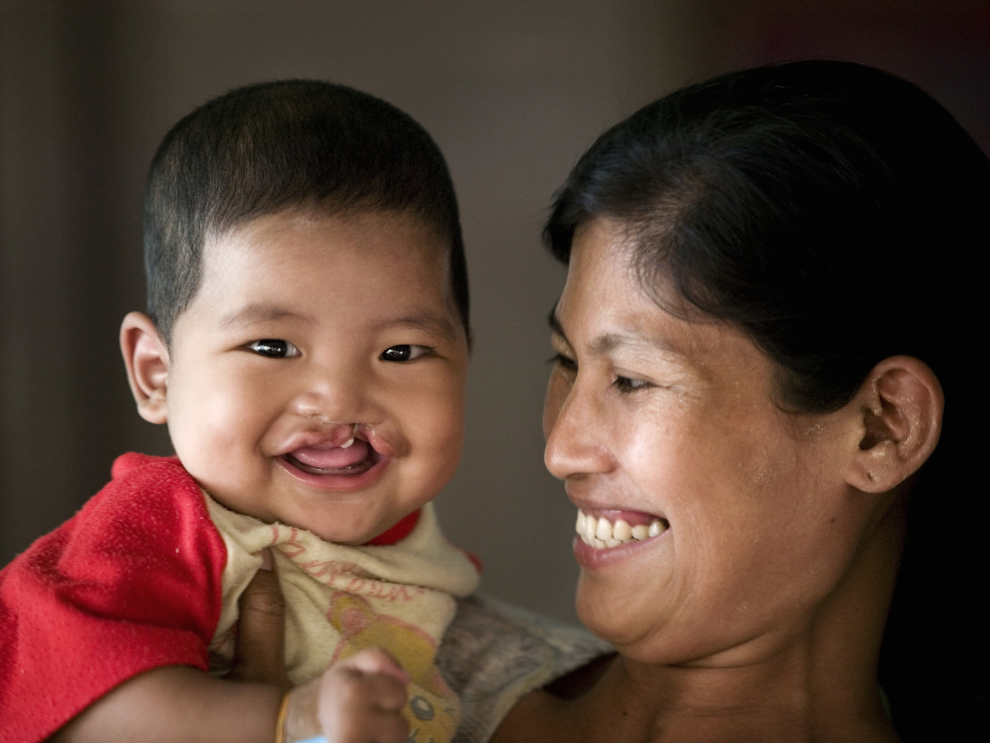 Han, before his cleft surgery.