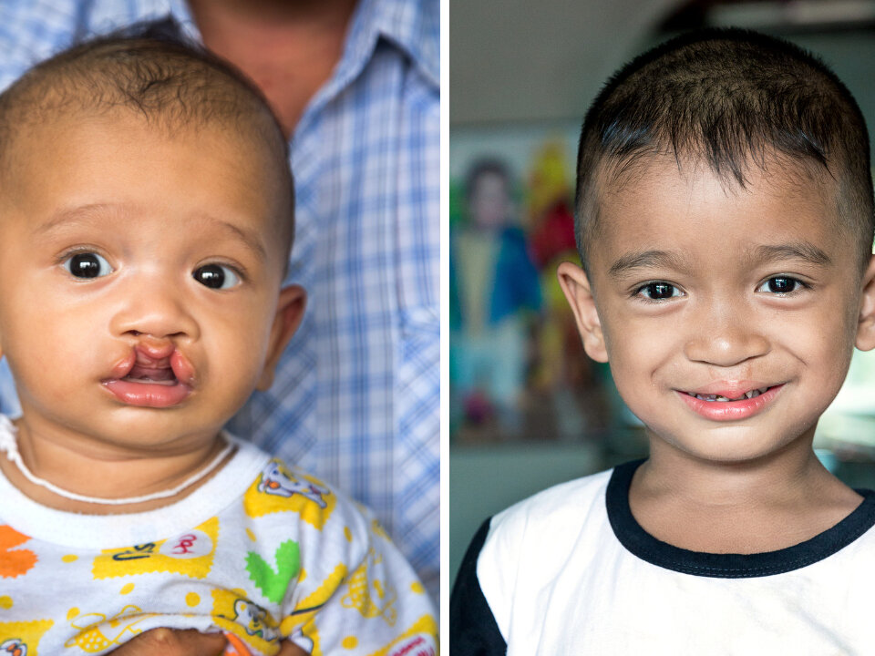 Ake, before and after surgery.