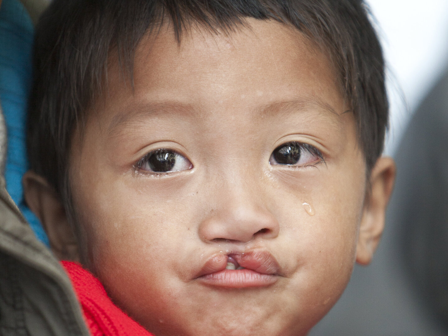 Bui, before surgery.