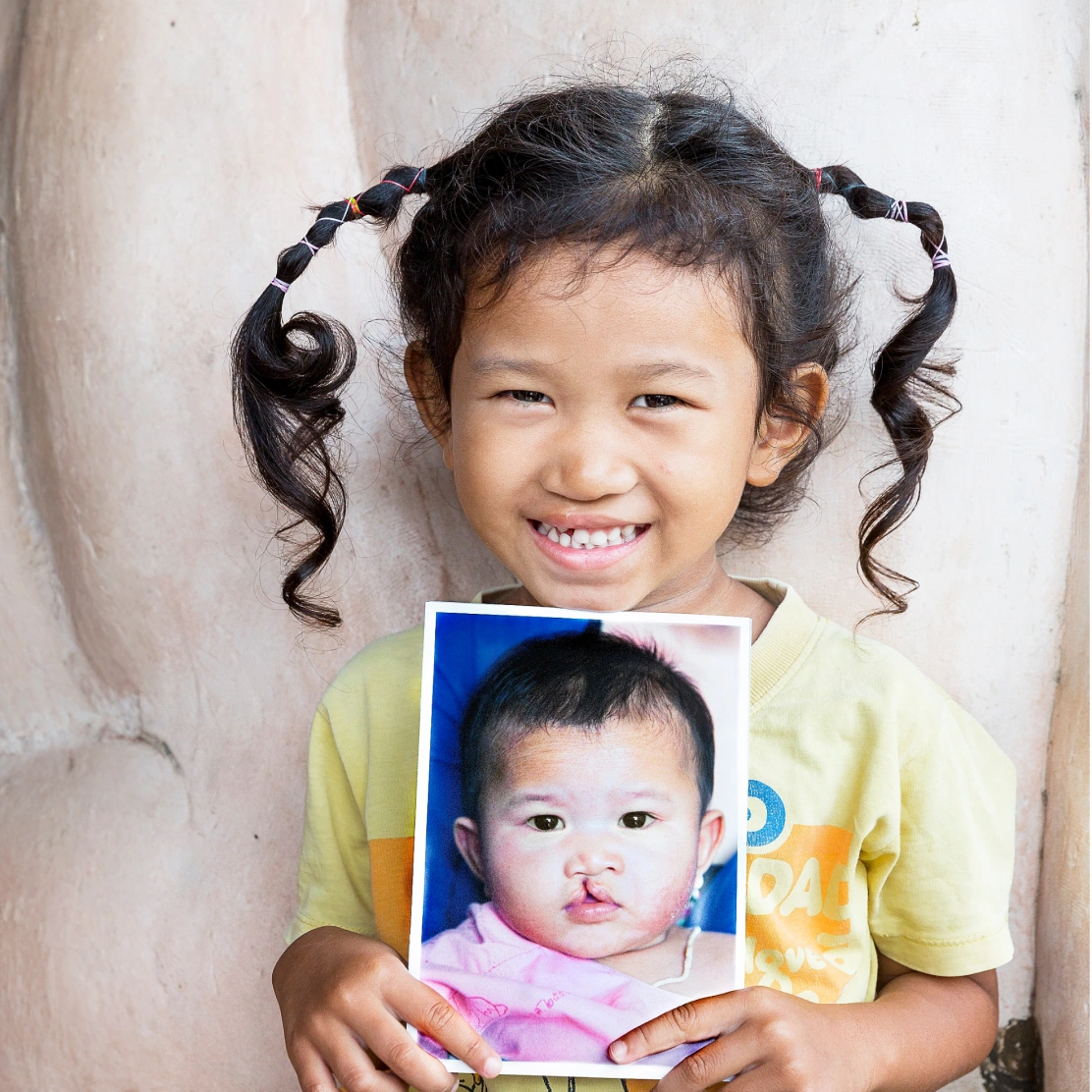 Tipayarat holds her before photo. She received treatment for her cleft lip from Operation Smile.